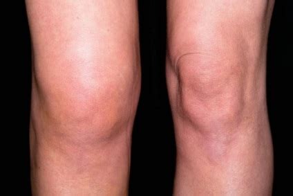 стъпка с артроза на коляното